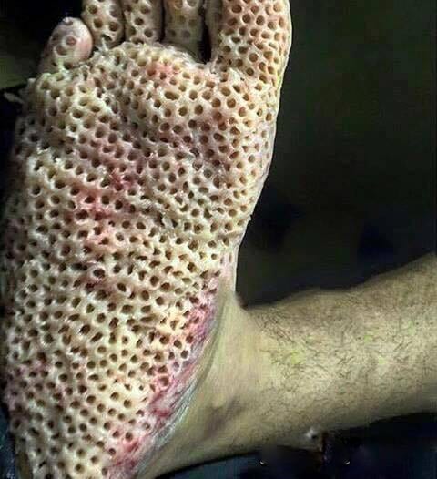 35406UNILAD imageoptim trypophobia foot